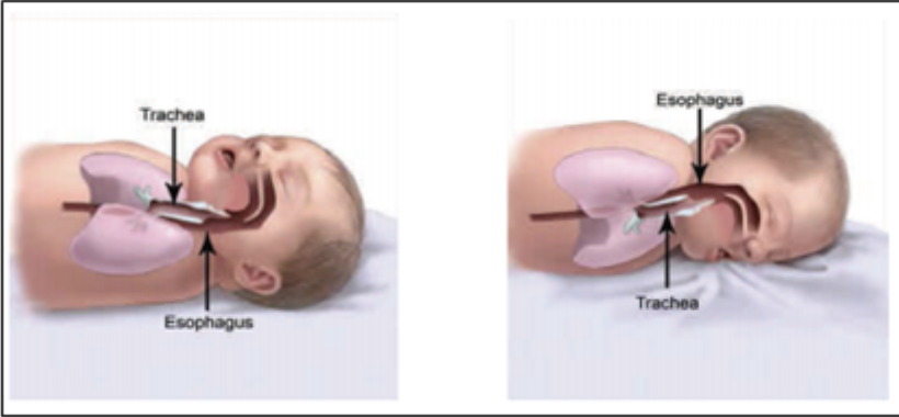 Airway positioning when infants sleep on their backs (left) and on their stomachs (right)